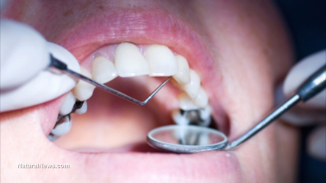 The dangers of conventional dentistry: Six biohazard metals lurking inside your mouth