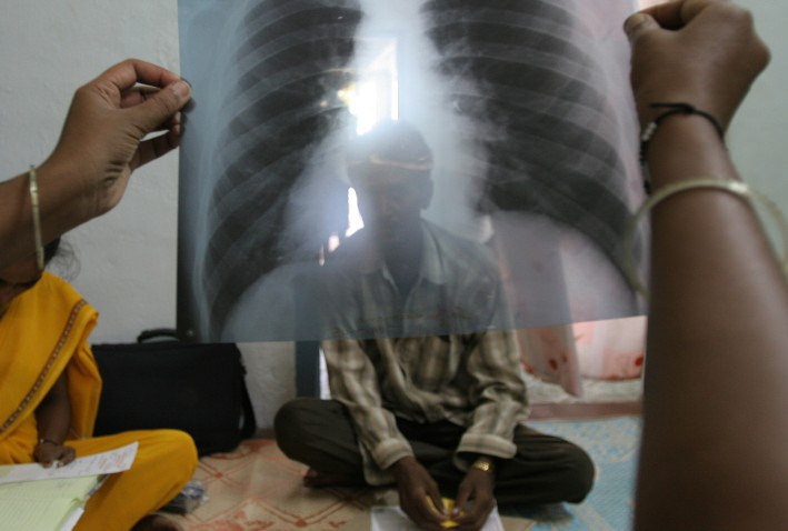 Muslim refugees bringing wave of tuberculosis to Minnesota… CDC silent, media refuses to accurately cover